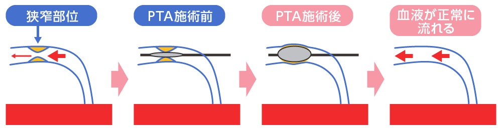PTA（血管拡張術）